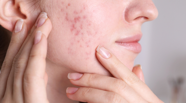 Tips voor hormonale acne