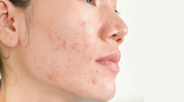 Zomer skincare tips voor de onzuivere huid